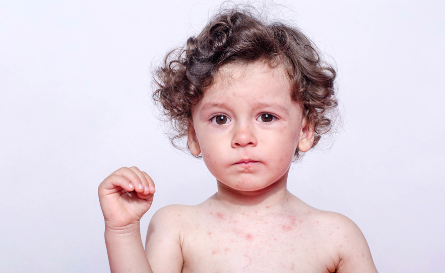 Allergie alimentaire enfant
